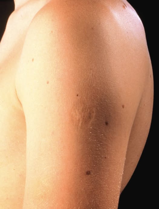 Smallpox Scar On People’s Upper Left Arm