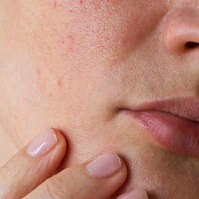 dry skin